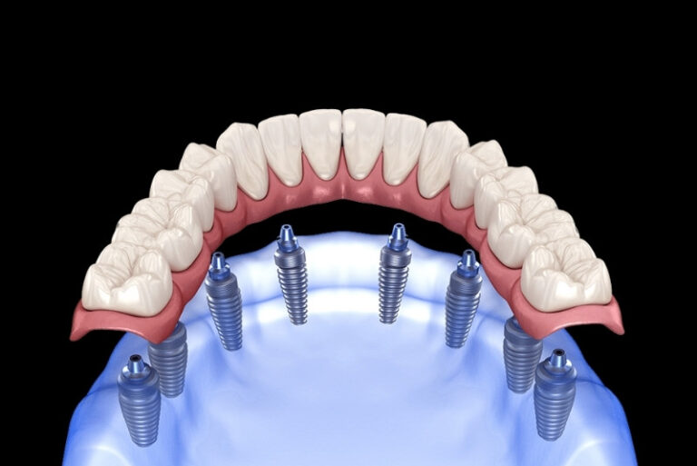 How Long Do All-on-8 Implants Last