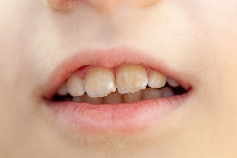 How To Get Rid Of White Spots On Teeth