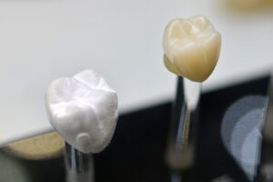 What Are CEREC Dental Crowns?