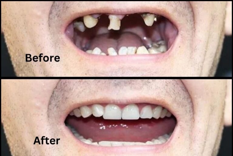 Who Is a Suitable Candidate for All-on-8 Dental Implants