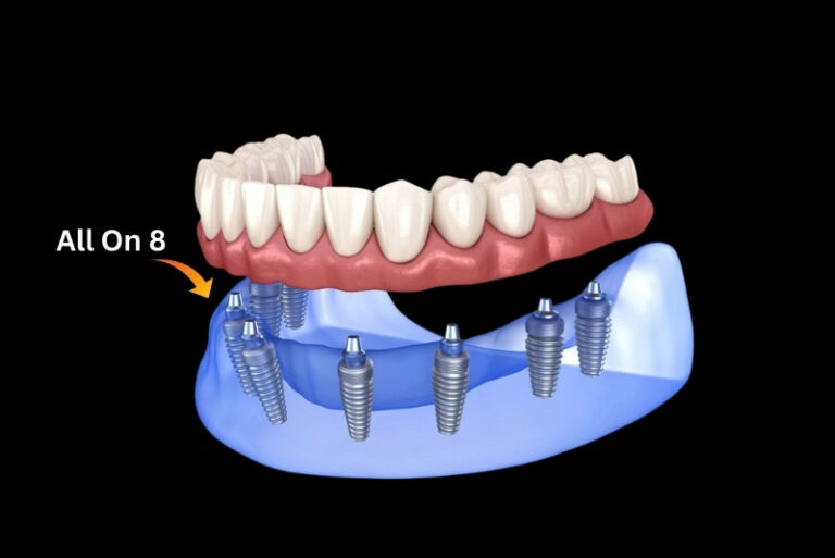 all-on-8-dental-implants-in-Turkey