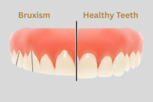 Bruxism Symptoms, Causes, and Treatments