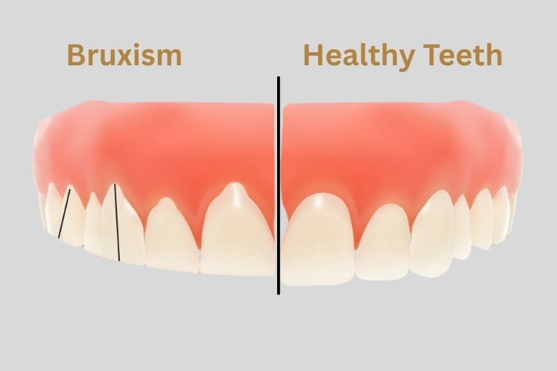 bruxism symptoms