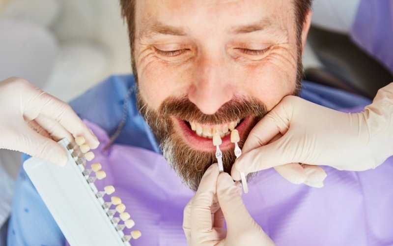 Can You Whiten Veneers