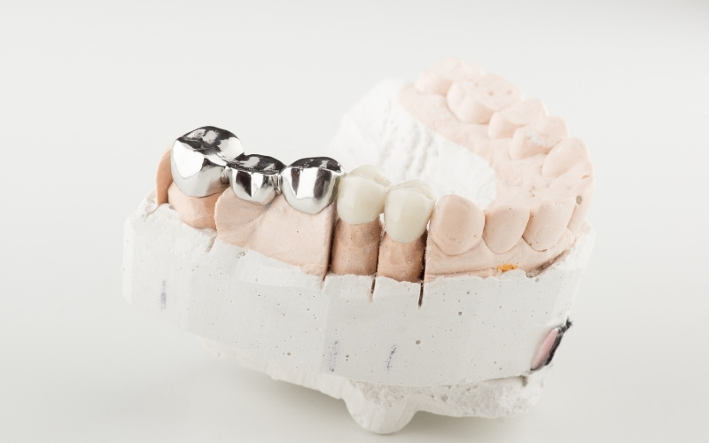 Can a Dental Bridge Be Removed and Recemented