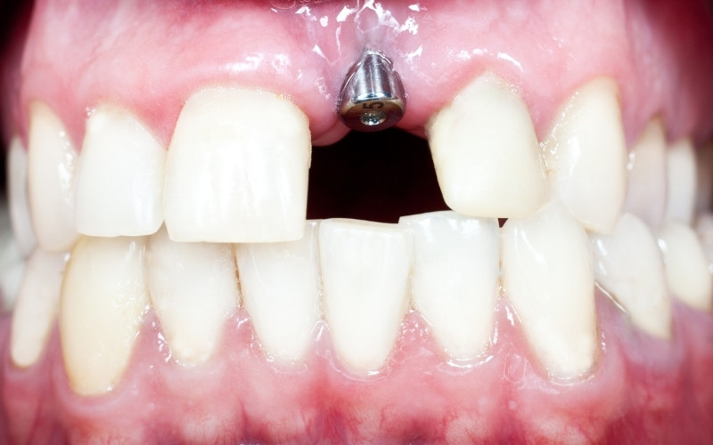 Dental Implant Screw Showing