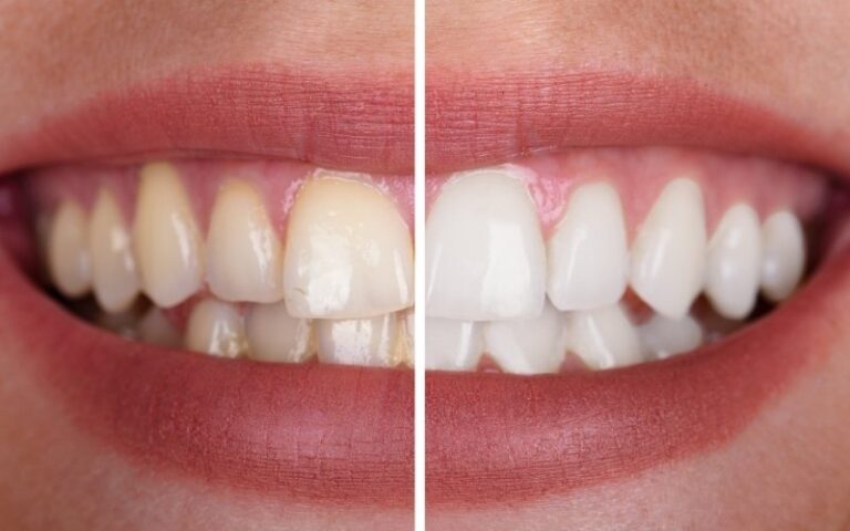 How Does Teeth Whitening Work