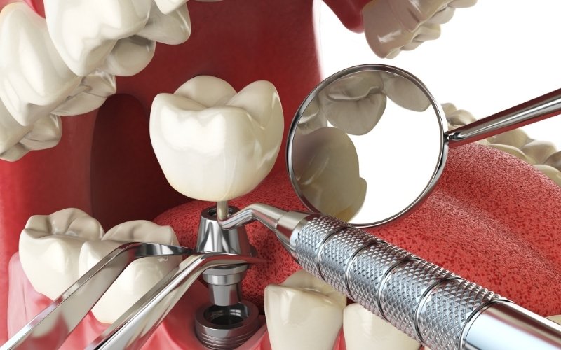 How Long Do Mini Dental Implants Last