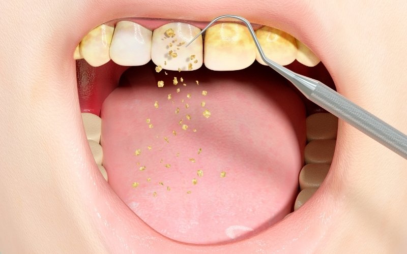 How Much Is Deep Cleaning Teeth Cost
