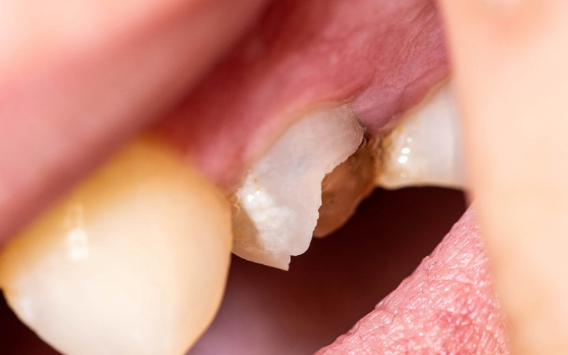 How to Fix a Chipped Tooth at Home