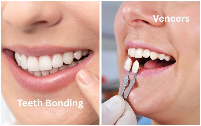Teeth Bonding vs Veneers