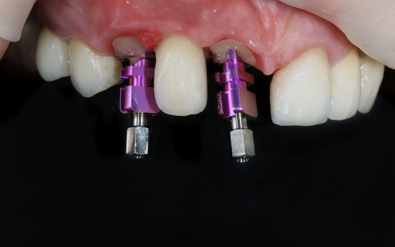 What Is Abutment In Dentistry