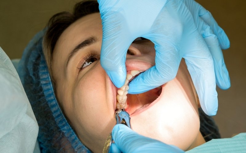 Why Experts Now Say Not To Remove Your Wisdom Teeth