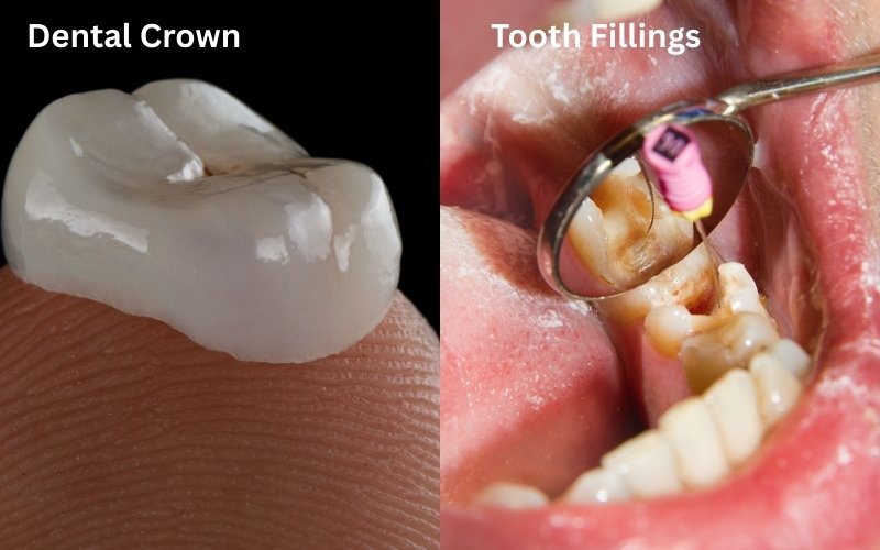 crown vs filling