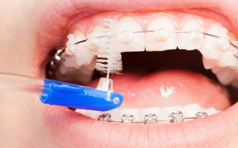 What Is An Interdental Brush And How To Use It