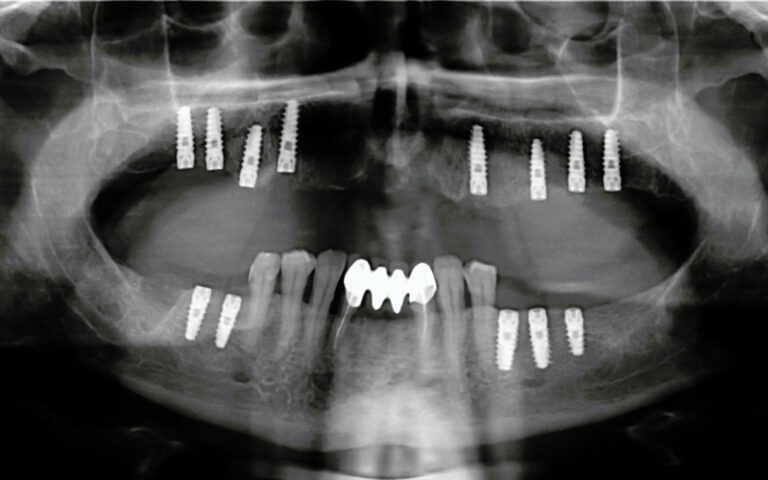Are Zygomatic Dental Implants Worth the Investment