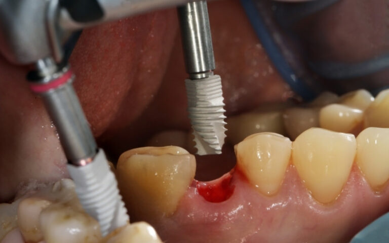 Can Zygomatic Implants Be Used in the Lower Jaw