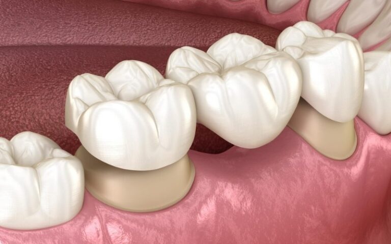 Dental Bridges