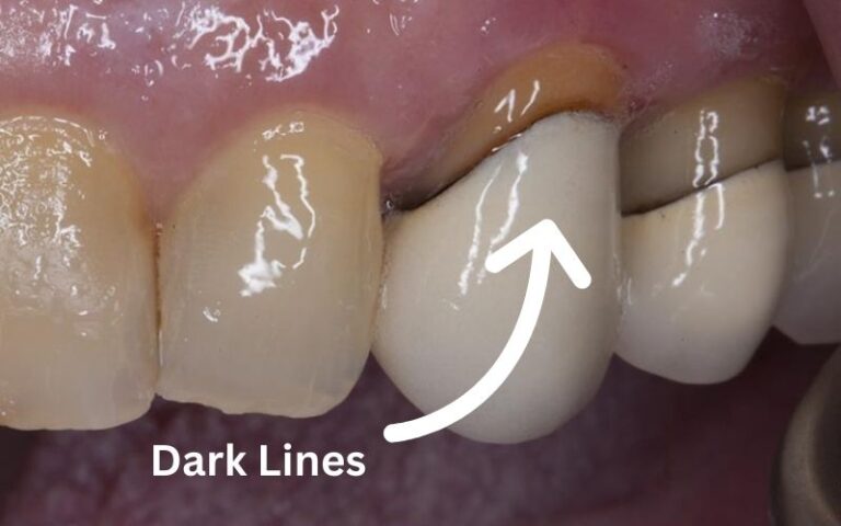 Gum Irritation, Recession, and Dark Lines