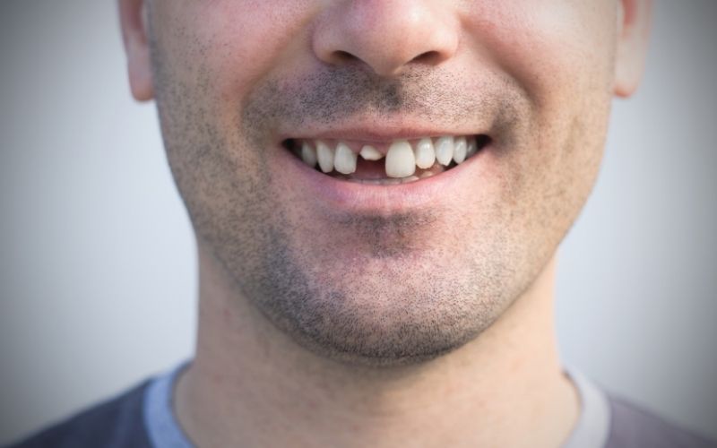 Diş Kırılması Nedir? Belirtisi ve Tedavisi