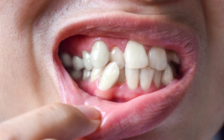 Is Hyperdontia Dangerous