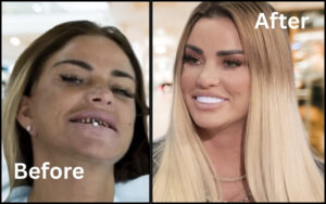 Katie Price’s Teeth Before and After: Her Veneers Journey
