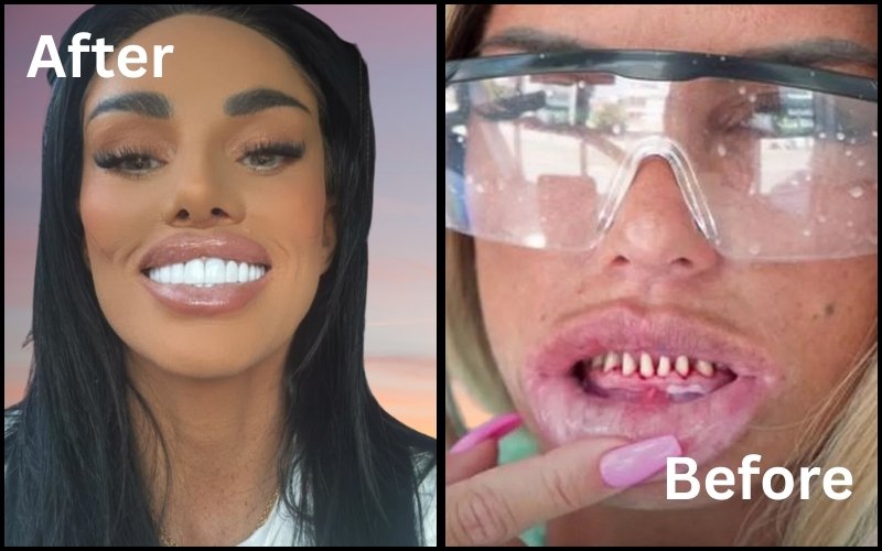 Katie Price Teeth Before & After
