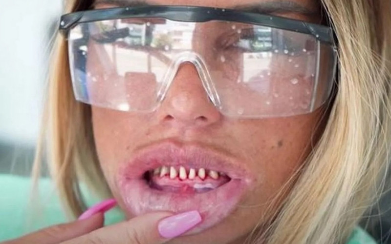 Katie Price’s Natural Teeth Before Veneers