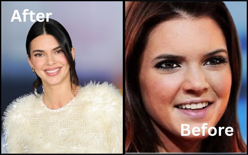 Kendall Jenner Before And After