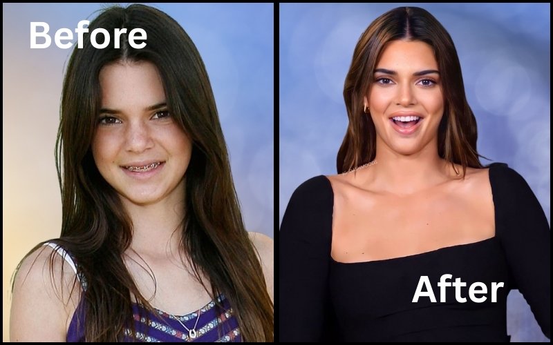 Kendall Jenner Teeth Before and After A Complete Smile Transformation