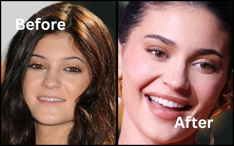 Kylie Jenner Teeth Before And After