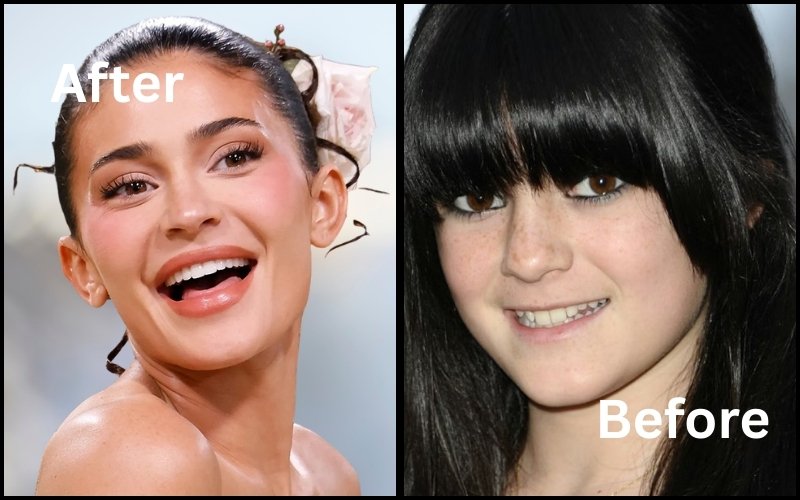 Kylie Jenner smile Before And After