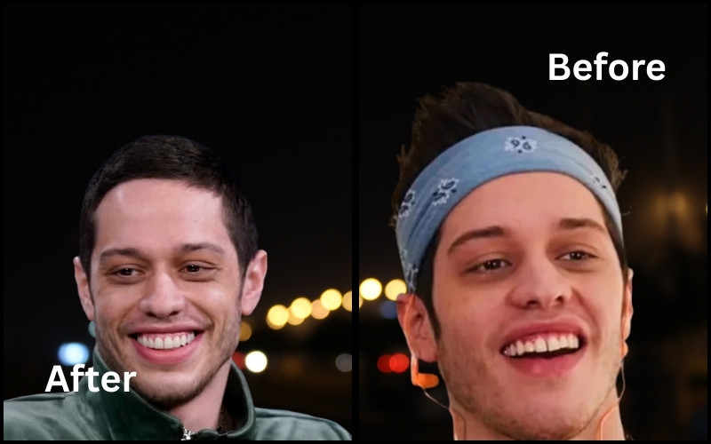 Pete Davidson smile Before and After