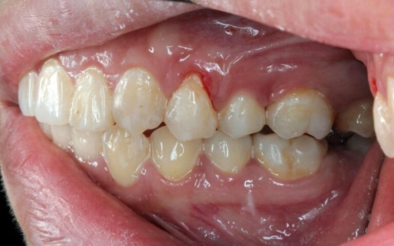 White spot on gum
