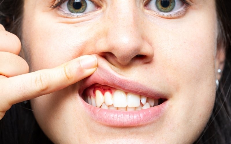White spots gums
