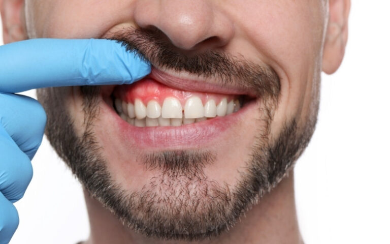 White spots on gums