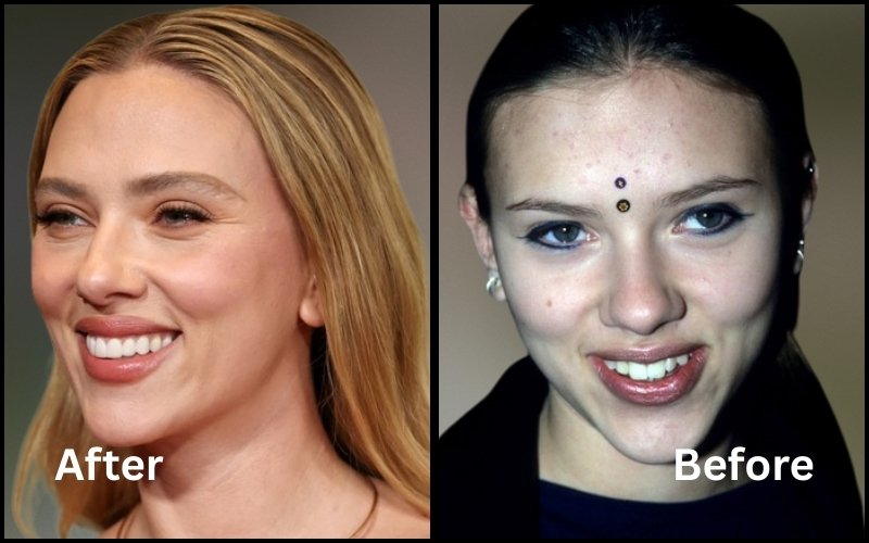 Scarlett Johansson veneers before and after