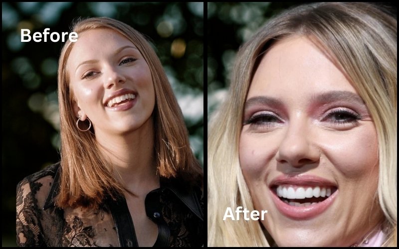 Scarlett Johansson veneers