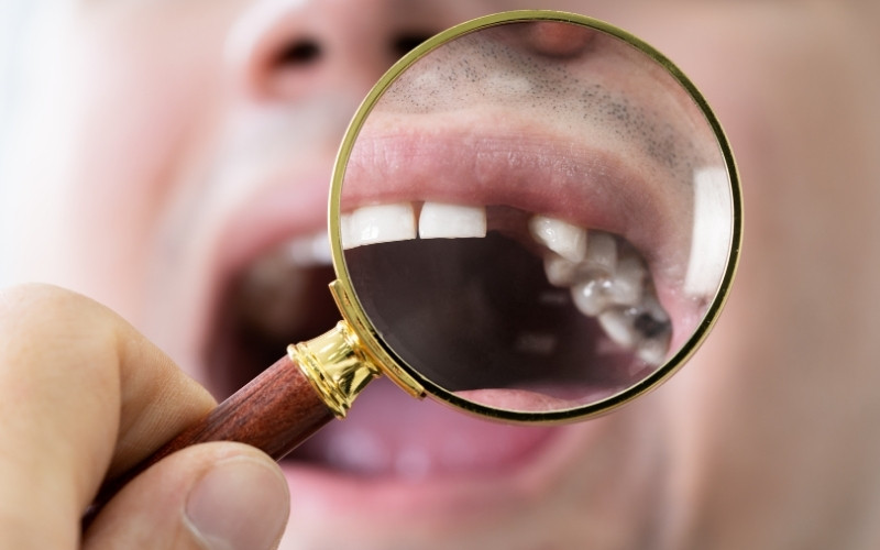 What Are The Recommended Teeth Covers For Missing Teeth