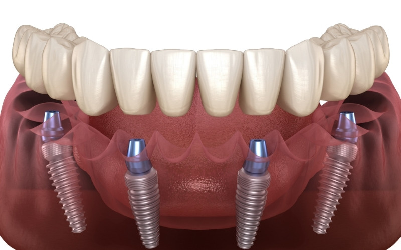 All-on-4 Implants