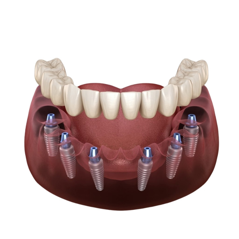 All on 6 Teeth Implant