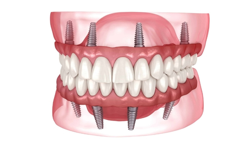 Full Mouth Implants