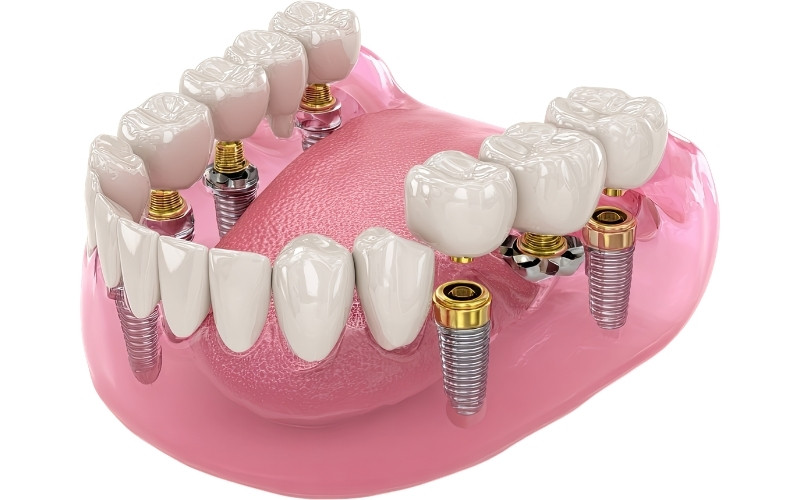 Multiple Tooth Implants