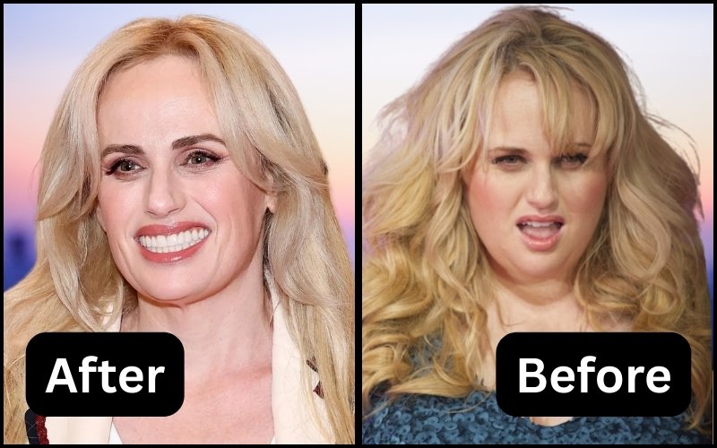Rebel Wilson Smile After & Before