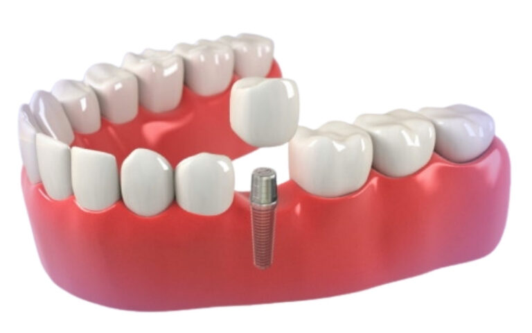 Same Day Dental Implant