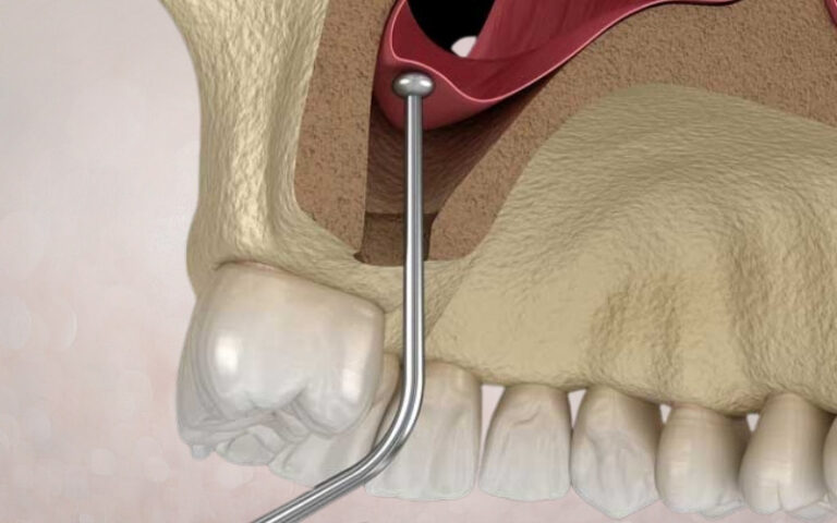 Sinus-Lifting