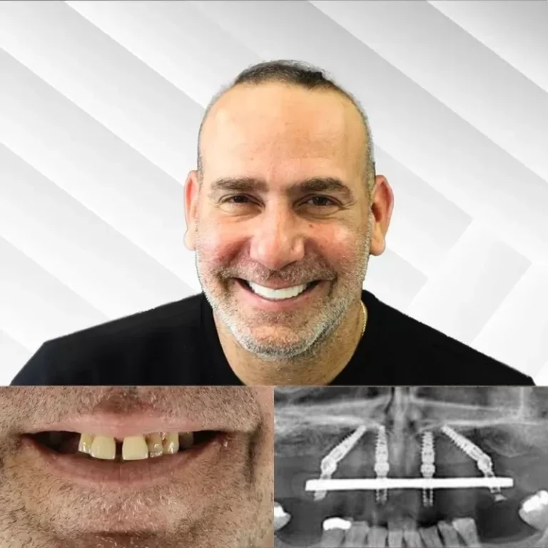 Xray-of-allon-4-implants-case-study-.webp