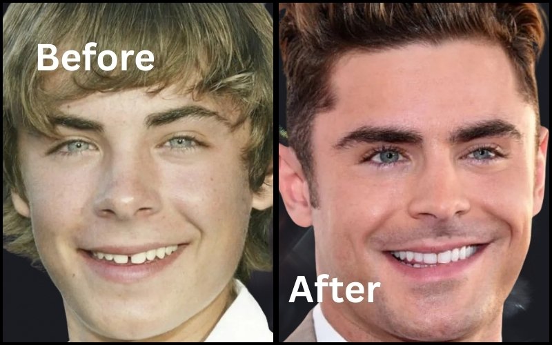 Zac Efron Veneers Before And After