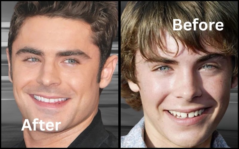 Zac Efron smile Veneers Before And After