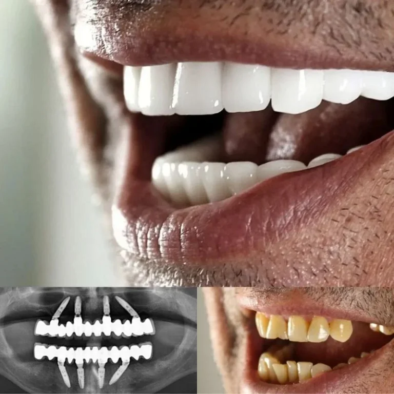 all on 4 dental implants turkey
